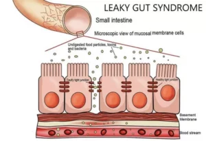 Leaky Gut Syndrome