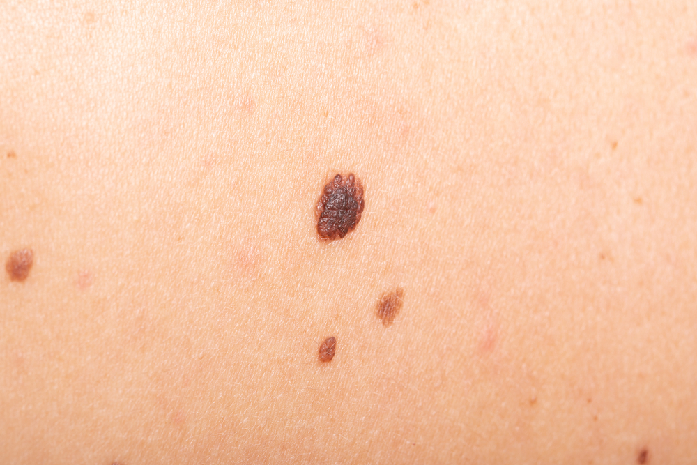 Mole, is it cancer?