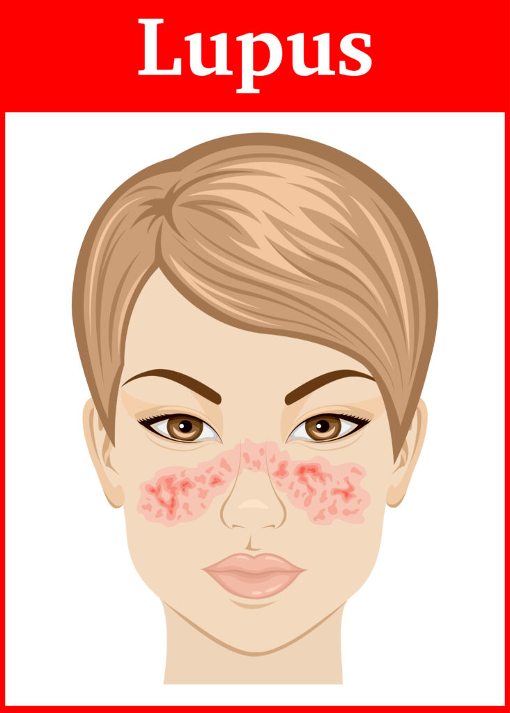 Lupus Atlanta Page autoimmune disease treatment consultation