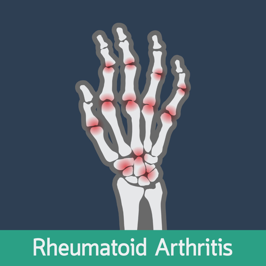Doctor discussing rheumatoid arthritis treatment with a patient in Atlanta.
